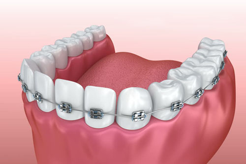 Tratamiento de Ortodoncia Dental.